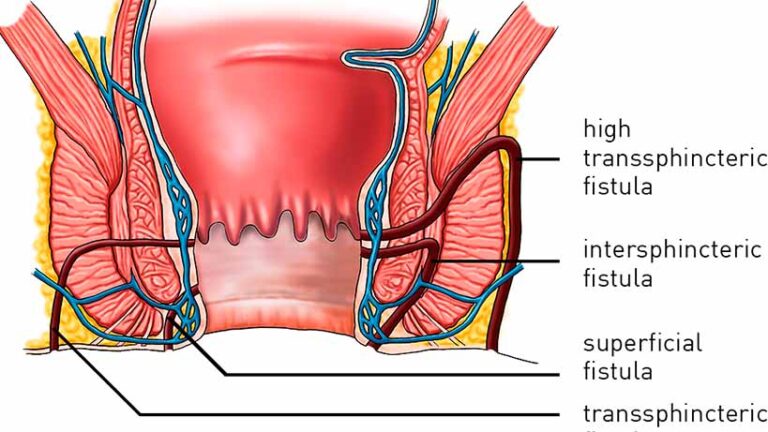 Anal Fistula Causes Symptoms Diagnosis Treatment Dr Abhijit