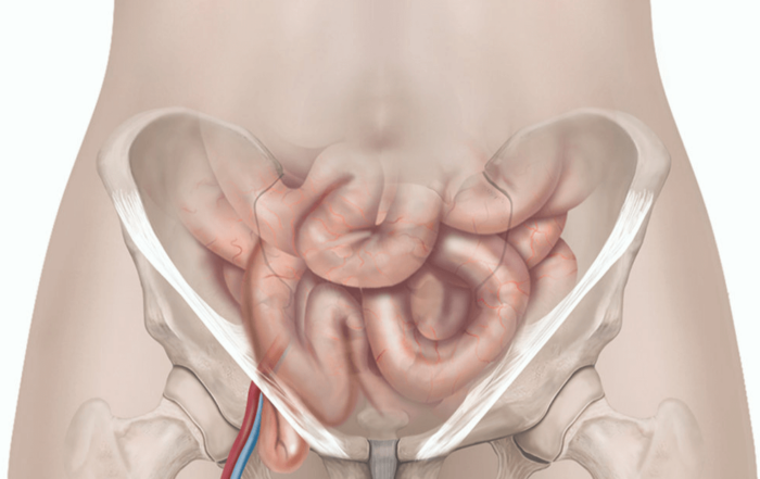 Femoral hernia treatment in Pune