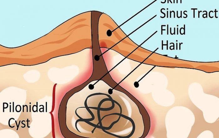 Pilonidal Sinus Specialist Doctor in Wanowrie, Fatima Nagar, Kondhwa, Undri, Manjri & Hadpsar
