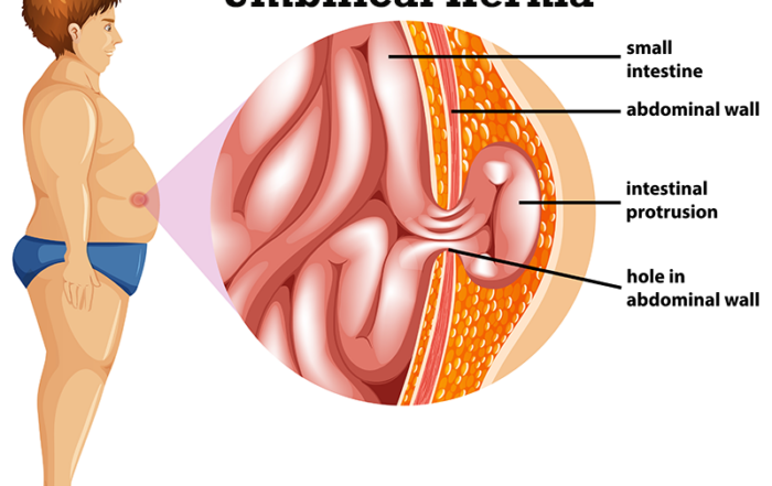 Best Hernia Specialist Doctor in Pune