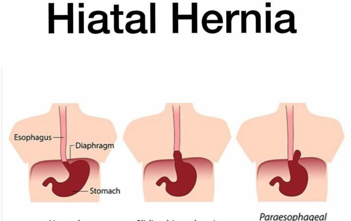 Hiatal Hernia Surgeon in Pune