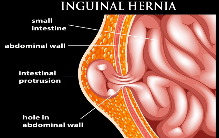 Inguinal hernia surgeon in Pune