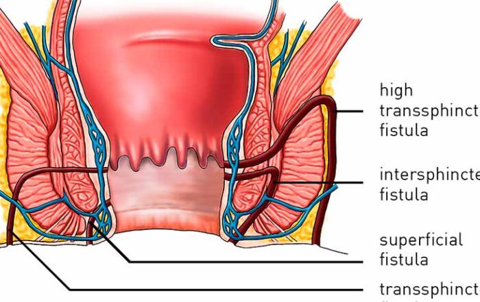 anal fistula specialist in pune