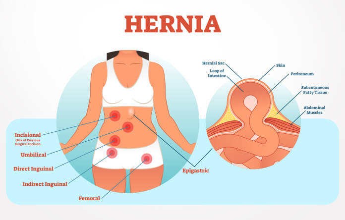 Inguinal hernia treatment in Pune