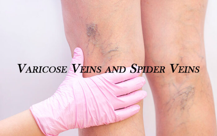 Varicose Veins Treatment in Hadapsar, Pune