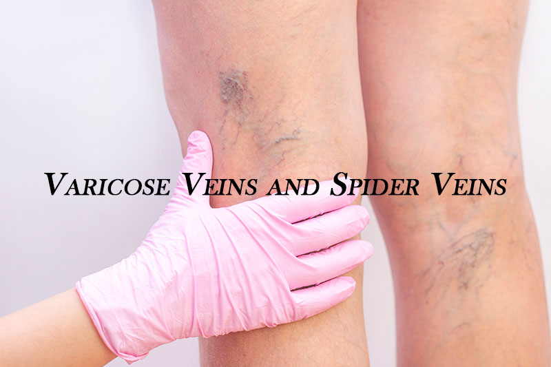Varicose Veins Behind the Knee  Vein Health Clinic Melbourne