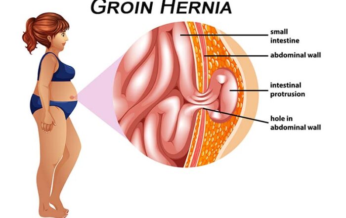 groin hernia surgeon in pune