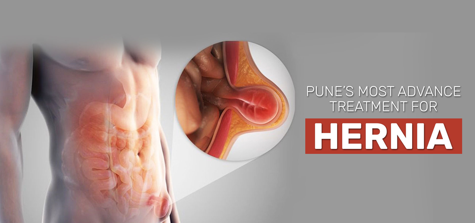pune is the most advance treatment for hernia