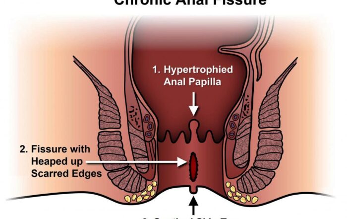 Anal Fissure Surgeon in Pune