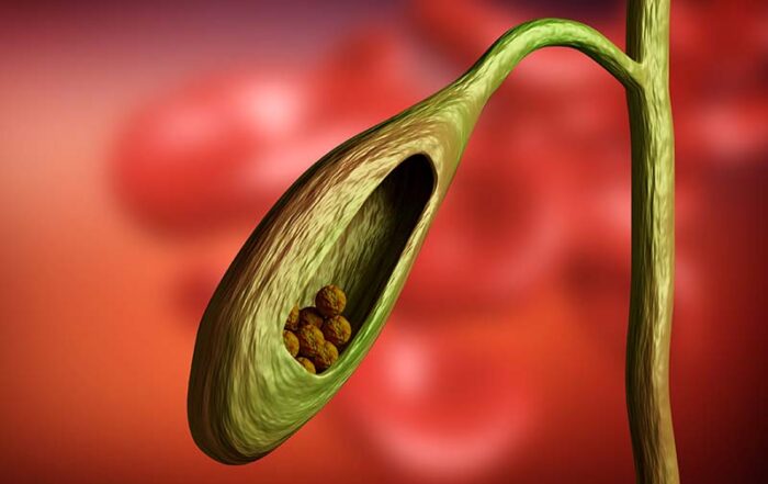 Gallbladder Stone Doctor in Hadapsar