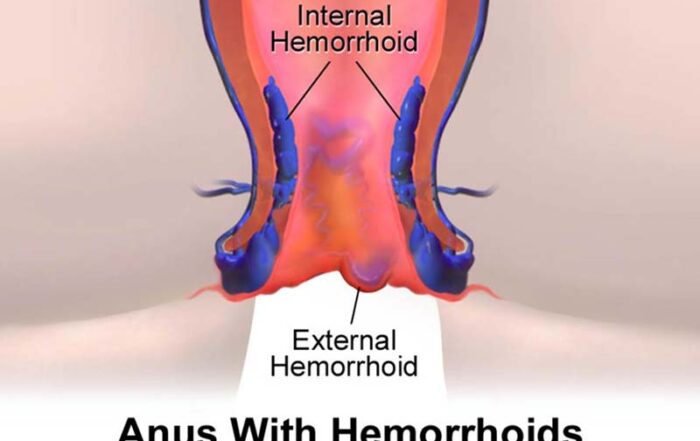 hemorrhoids laser surgery cost in hadapsar