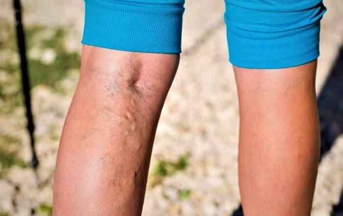 Hemorrhoids and Varicose Veins Treatment in Hadapsar, Pune