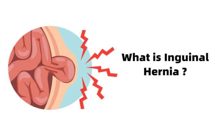 Best Clinic for Hernia Treatment in Pune