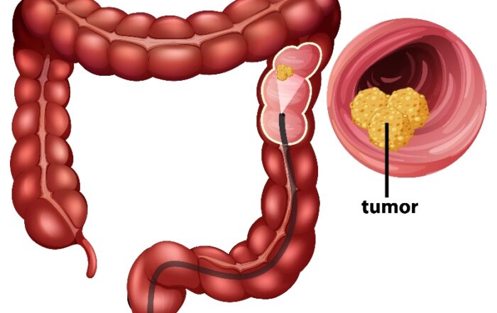 Best Clinic to do Colorectal Surgery in Pune