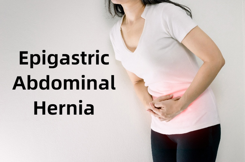 An Epigastric Abdominal Hernia Symptoms for Female