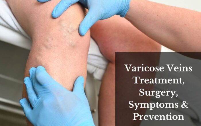 varicose treatment