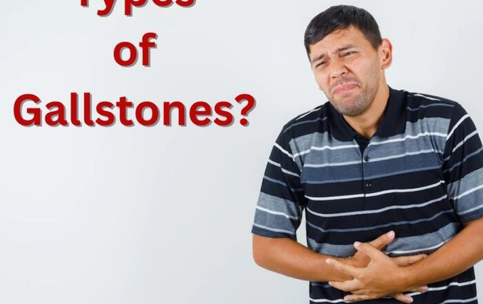 What are the 3 types of Gallstones?