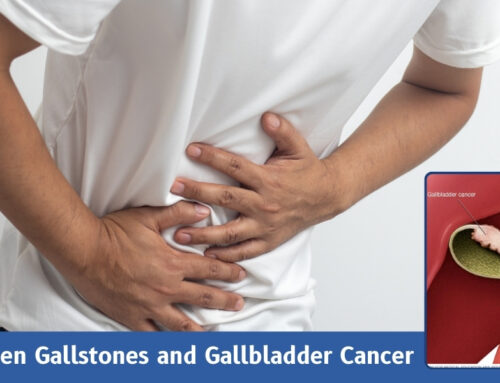 Link Between Gallstones and Gallbladder Cancer: What You Need to Know
