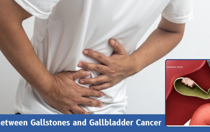 Link Between Gallstones and Gallbladder Cancer: What You Need to Know