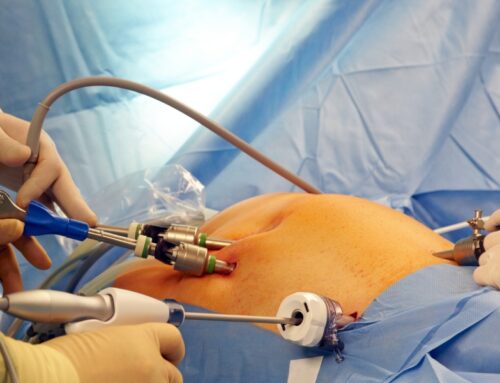 Which is Better Laparoscopy or Open Surgery For Hernia?