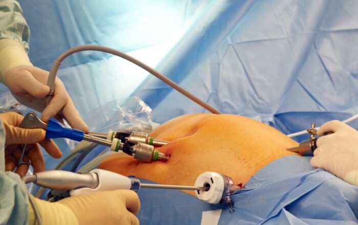 Which is Better Laparoscopy or Open Surgery For Hernia?