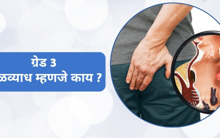 ग्रेड 3 मूळव्याध म्हणजे काय ?