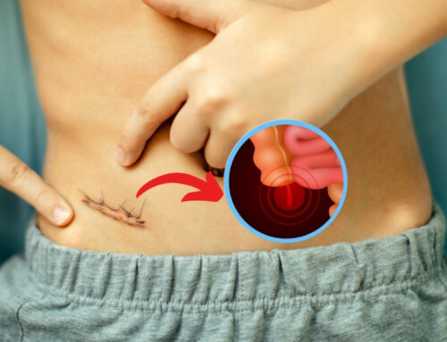 Do’s and Don’ts After Appendix Surgery