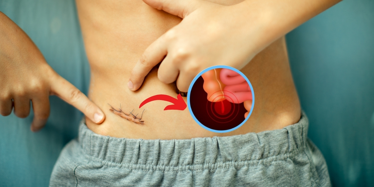 Do's and don'ts after appendix surgery