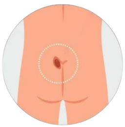Pilonidal Sinus (1)
